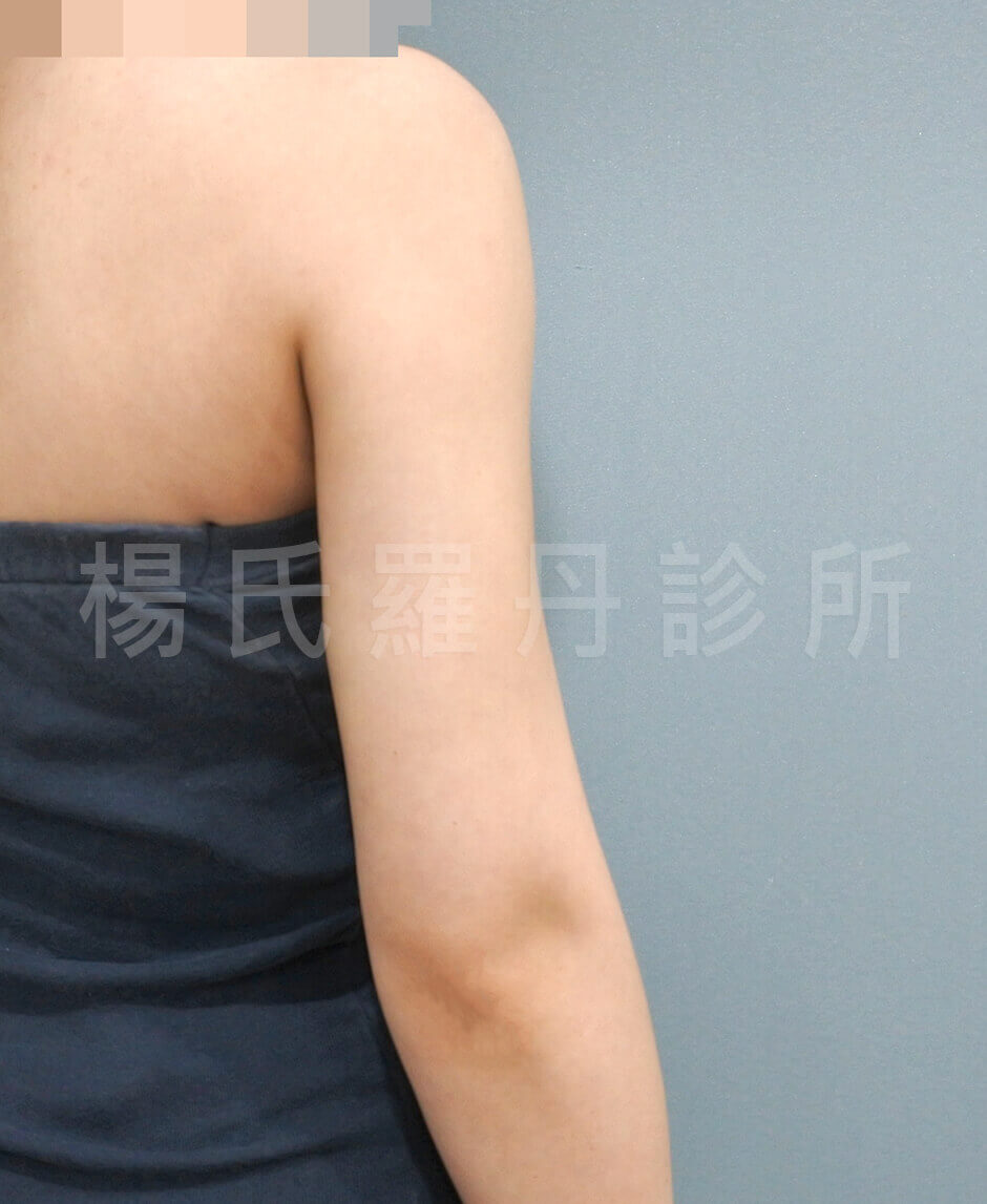 手臂 瘦手臂 掰掰袖 雷射減脂